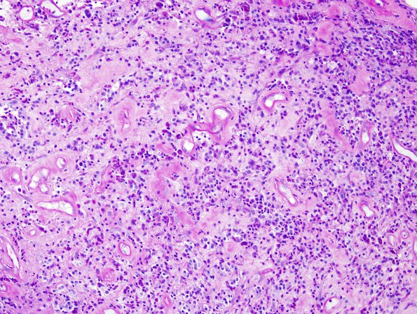 4K Lymphoma, B cell & sentinel (Case 4) neoplastic area LFB-PAS