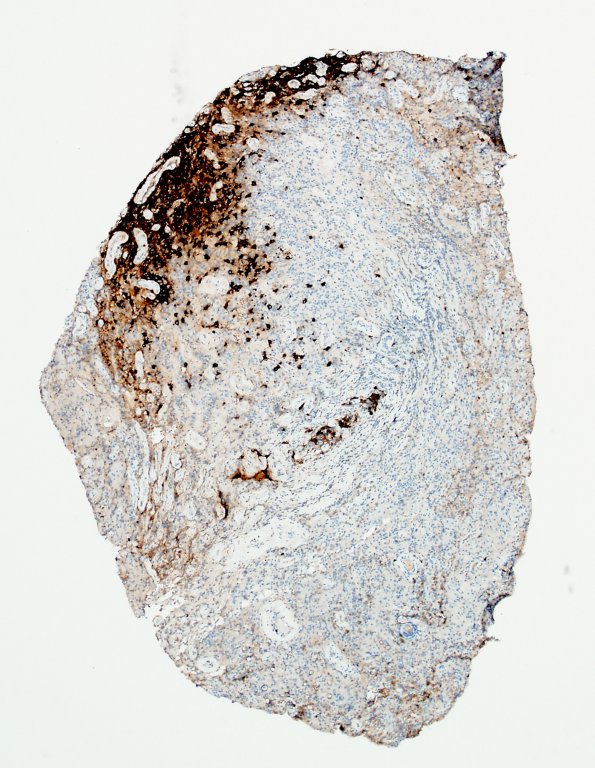 4L1 Lymphoma, B cell & sentinel (Case 4) neoplastic area CD20 4X