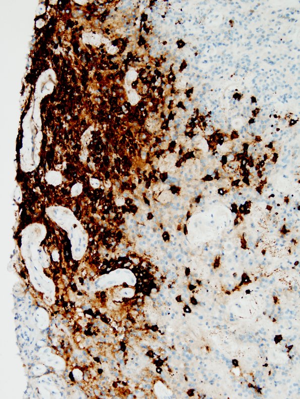 4L2 Lymphoma, B cell & sentinel (Case 4) neoplastic area CD20 20X