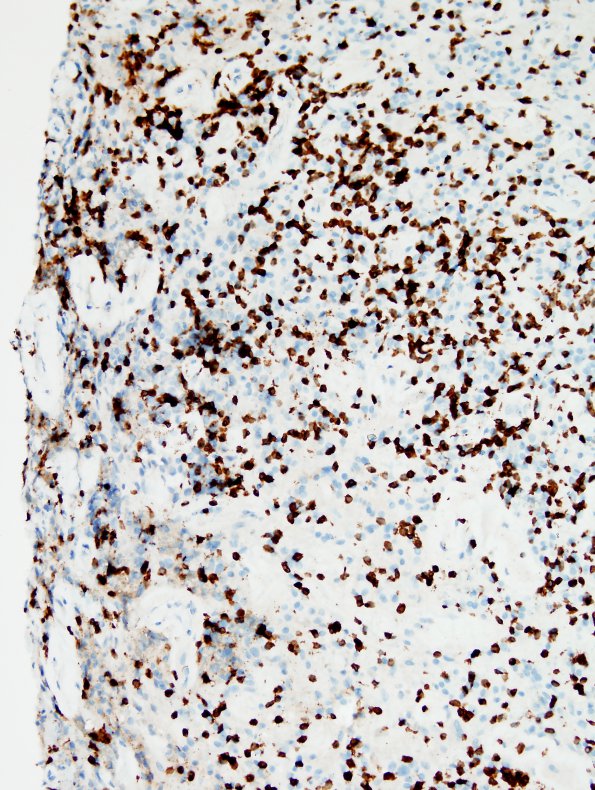 4M2 Lymphoma, B cell & sentinel (Case 4) neoplastic area CD3 20X