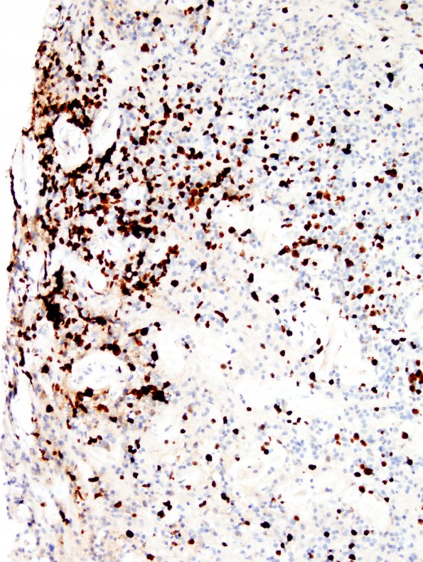 4N2 Lymphoma, B cell & sentinel (Case 4) neoplastic area Ki67 20X