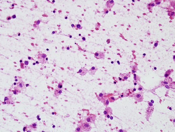 4O Lymphoma, B cell & sentinel (Case 4) neoplastic area H&E smear 3