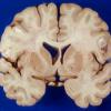 1A1 Adrenoleukodystrophy (Case 1) 4