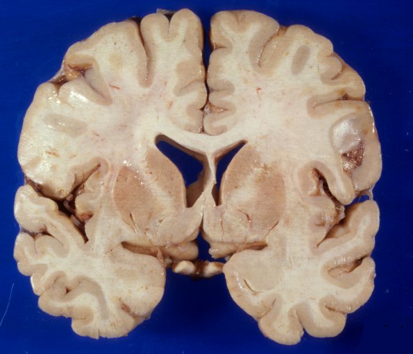 1A1 Adrenoleukodystrophy (Case 1) 4