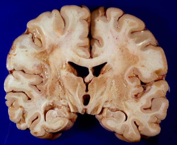 1A2 Adrenoleukodystrophy (Case 1) 9