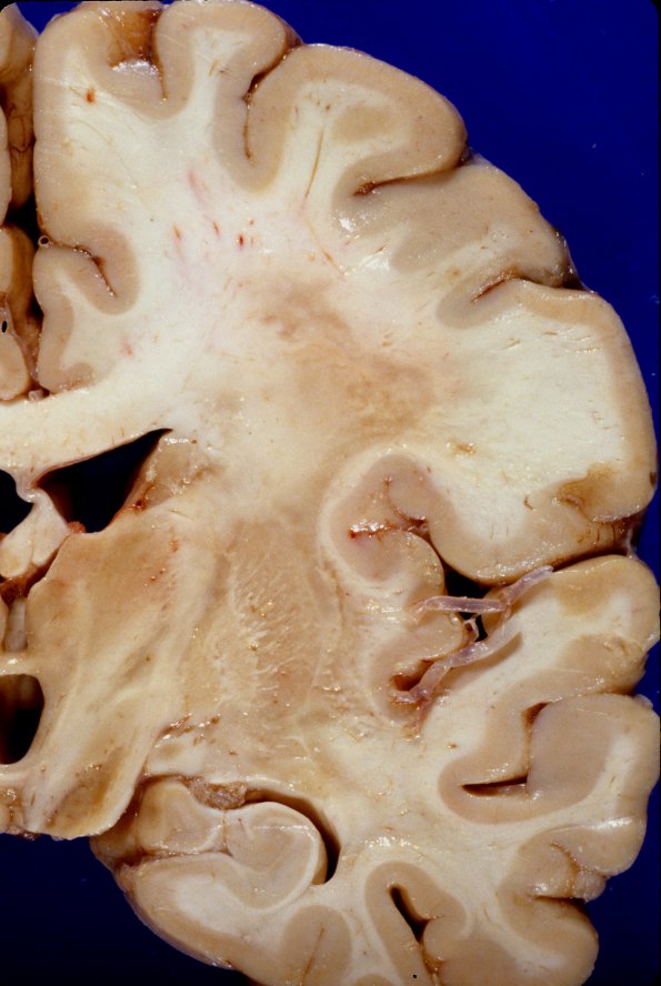 1A3 Adrenoleukodystrophy (Case 1) 8