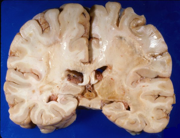 1A4 Adrenoleukodystrophy (Case 1) 3