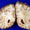 1A5 Adrenoleukodystrophy (Case 1) 4A