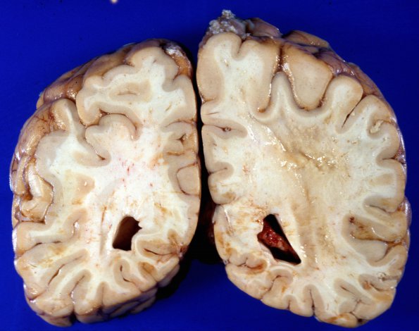 1A5 Adrenoleukodystrophy (Case 1) 4A