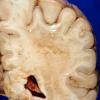 1A6 Adrenoleukodystrophy (Case 1) 2