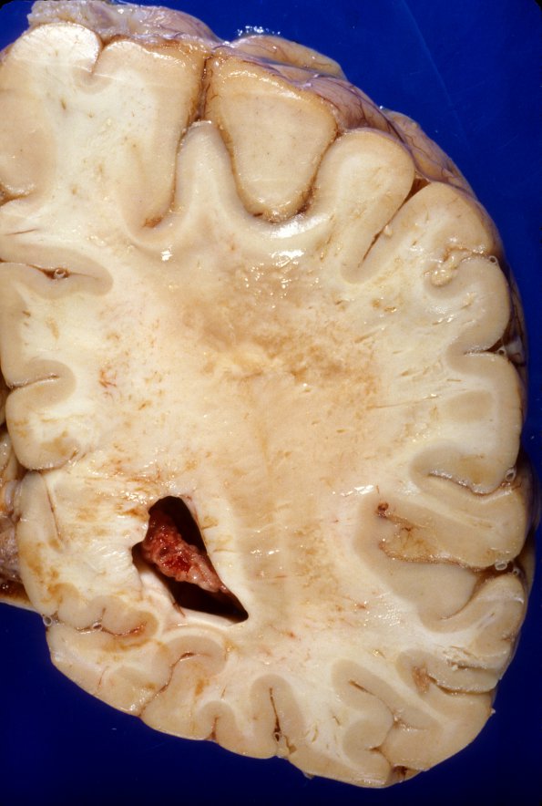 1A6 Adrenoleukodystrophy (Case 1) 2