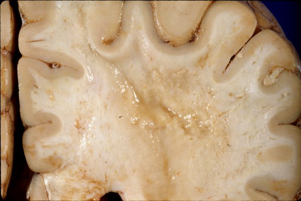 1A7 Adrenoleukodystrophy (Case 1) 1