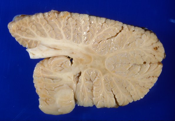 1A8 Adrenoleukodystrophy (Case 1) 5