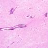 1B2 Adrenoleukodystrophy (Case 1) H&E 3