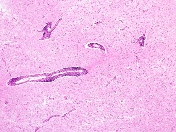 1B2 Adrenoleukodystrophy (Case 1) H&E 3