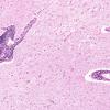 1B3 Adrenoleukodystrophy (Case 1) H&E 2