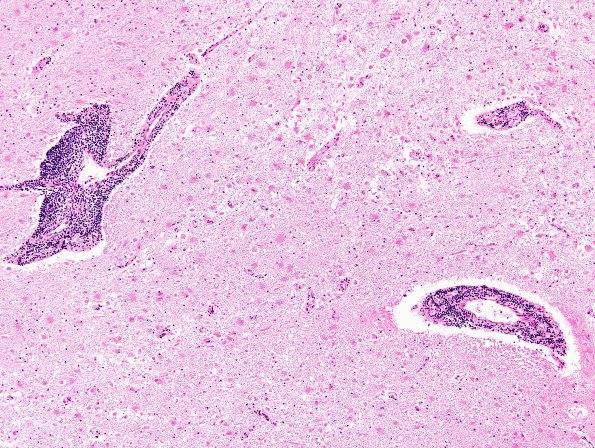 1B3 Adrenoleukodystrophy (Case 1) H&E 2