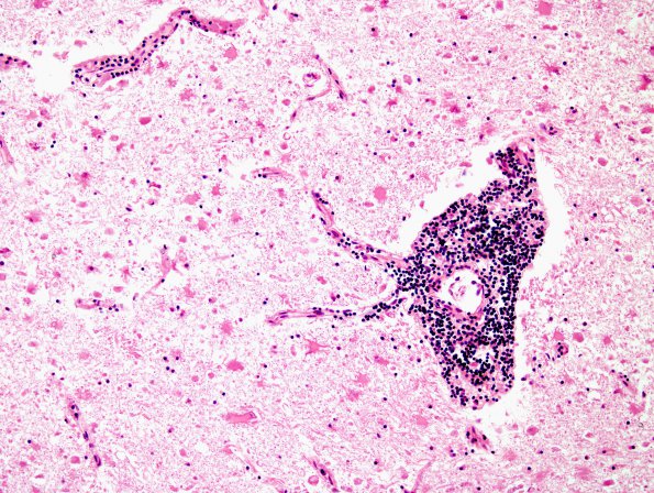 1B4 Adrenoleukodystrophy (Case 1) H&E 1