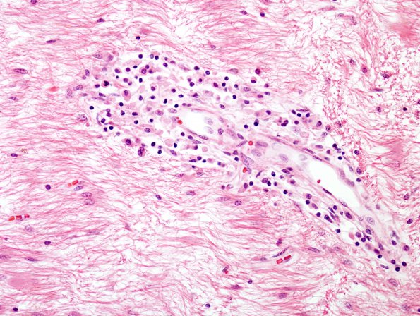 1B5 Adrenoleukodystrophy (Case 1) H&E 1