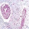 1C10 Adrenoleukodystrophy LFB-PAS (Case 1) 1