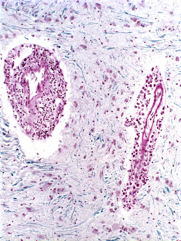 1C10 Adrenoleukodystrophy LFB-PAS (Case 1) 1