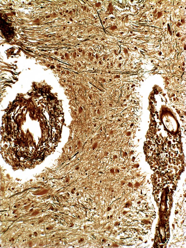 1C11 Adrenoleukodystrophy Biel (Case 1) 1