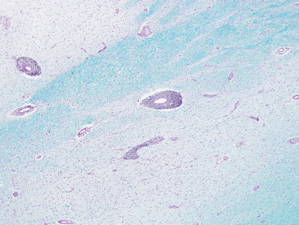 1C2 Adrenoleukodystrophy (Case 1) LFB-PAS 6