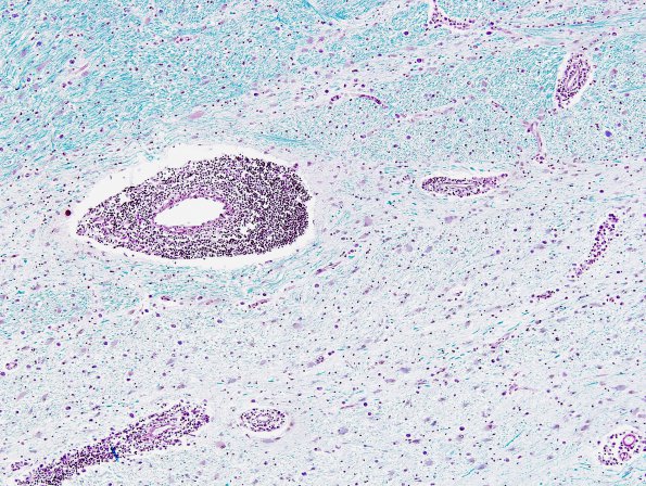 1C3 Adrenoleukodystrophy (Case 1) LFB-PAS 5