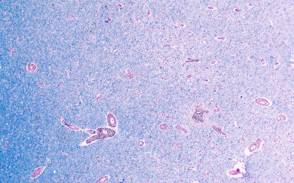 1C5 Adrenoleukodystrophy (Case 1) LFB-PAS series 4X