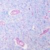 1C6 Adrenoleukodystrophy (Case 1) LFB-PAS series 10X