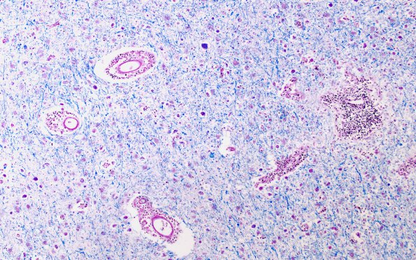 1C6 Adrenoleukodystrophy (Case 1) LFB-PAS series 10X