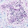 1C7 Adrenoleukodystrophy (Case 1) LFB-PAS series 40X