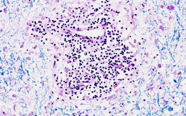 1C7 Adrenoleukodystrophy (Case 1) LFB-PAS series 40X