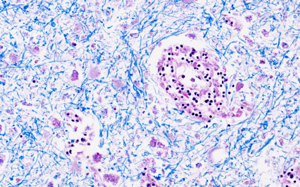 1C8 Adrenoleukodystrophy (Case 1) LFB-PAS 40X 2