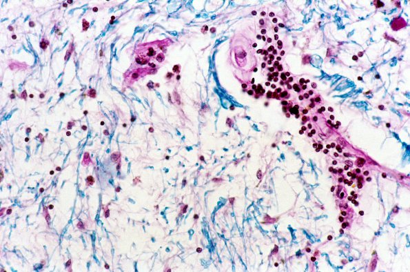 1C9 Adrenoleukodystrophy 45 (Case 1)