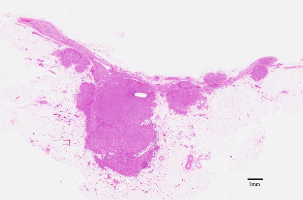 1D2 Adrenoleukodystrophy (Case 1) Adrenal  (length 1