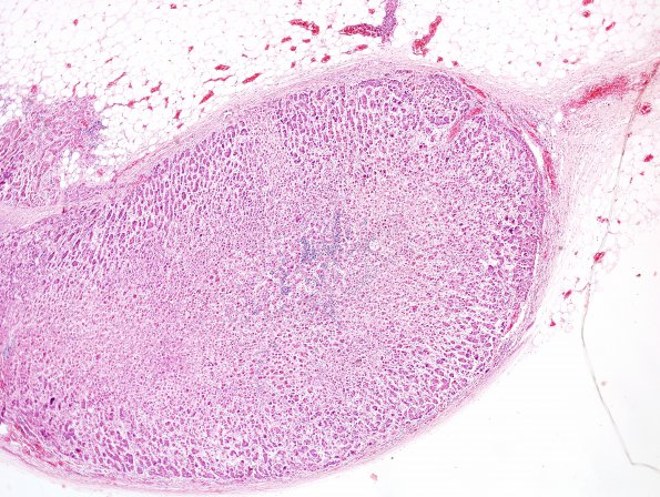 1D3 Adrenoleukodystrophy (Case 1) Adrenal