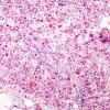 1D4 Adrenoleukodystrophy (Case 1) Adrenal 1 - Copy