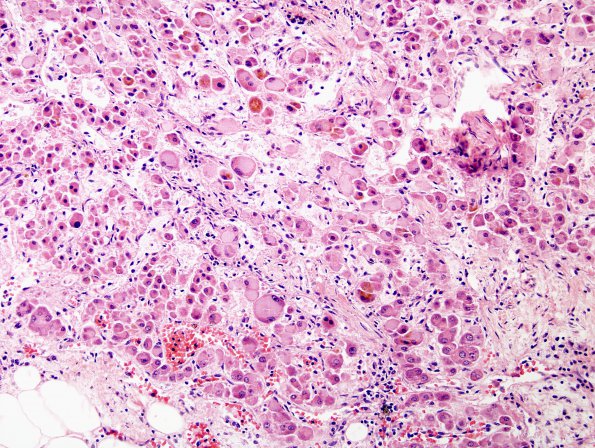 1D4 Adrenoleukodystrophy (Case 1) Adrenal 1 - Copy