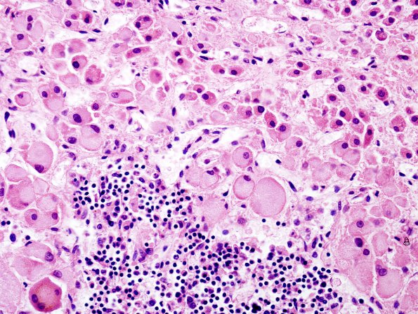 1D5 Adrenoleukodystrophy (Case 1) Adrenal 5