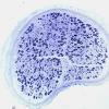 1E Adrenoleukodystrophy (Case 1) sural nerve