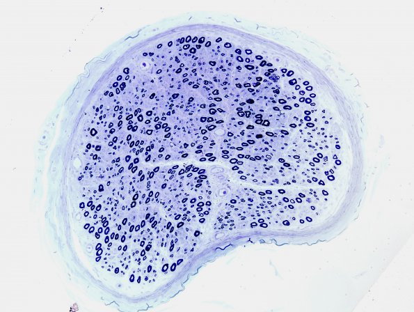 1E Adrenoleukodystrophy (Case 1) sural nerve