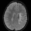 2A1 Adrenoleukodystrophy (Case 2) T2 FLAIR 1 - Copy