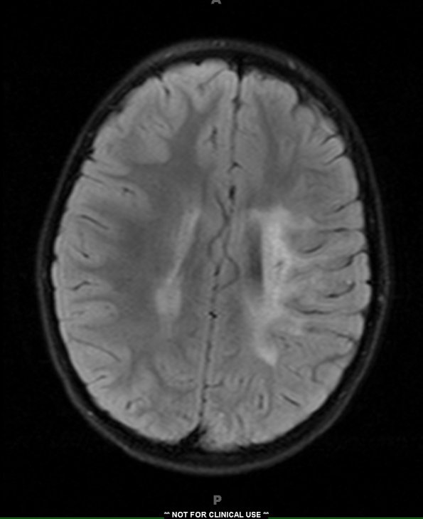 2A1 Adrenoleukodystrophy (Case 2) T2 FLAIR 1 - Copy