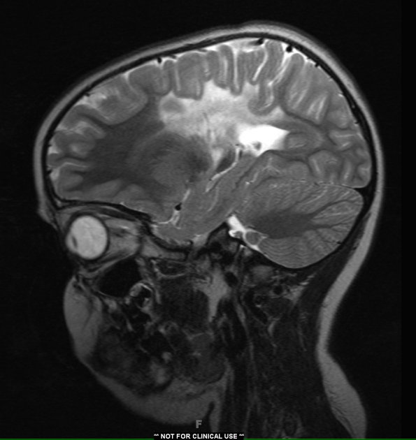 2A2 Adrenoleukodystrophy (Case 2) T2 2 - Copy