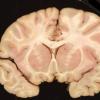 2B1 Adrenoleukodystrophy (Case 2) 3