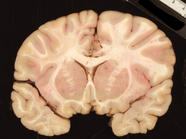 2B1 Adrenoleukodystrophy (Case 2) 3