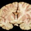 2B2 Adrenoleukodystrophy (Case 2) 4