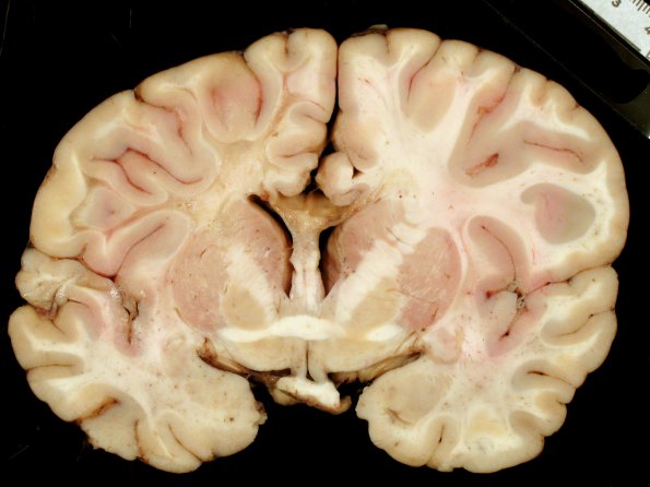 2B2 Adrenoleukodystrophy (Case 2) 4