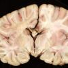 2B4 Adrenoleukodystrophy (Case 2) 6